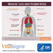 Tobacco Use Causes More Than Just Lung Cancer It Can Cause At Least 12 Cancers Throughout The Body Including Cancers Of The Mouth And Throat Voice Box Stom