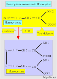 Image result for Homocystinuria