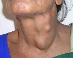 Lung cancer symptoms include difficulty breathing, headaches, and persistent chest pain. Cancer Types Head And Neck Cancer Radtec
