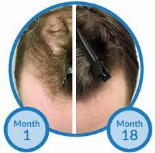 Minoxodil is a vasodilator which has been shown to reduce and slow hair loss in those who suffer from alopecia. Minoxidil Proven For Hair Loss