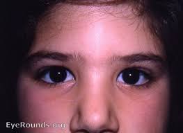 Noonan syndrome is most often an autosomal dominant genetic disorder caused by abnormalities (mutations) in several different genes, the main ones being: Epicanthal Folds Eyerounds Org Online Ophthalmic Atlas