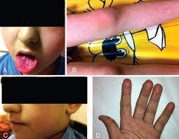 Clinical Findings Of The Patient Compatible With Kawasaki Disease Download Scientific Diagram