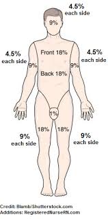 Rule Of Nines For Burns In An Adult Nclex Review