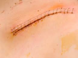 It includes the normal development of a thickening area along the incisional line indicating deposition of new collagen in the wound, often referred to as a healing ridge. What Are The Best Uses For Surgical Glue In Medicine Photo Information Blog