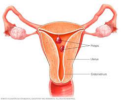 Common symptoms of uterine cancer are abnormal vaginal bleeding and bleeding after menopause. Uterine Polyps Symptoms And Causes Mayo Clinic