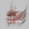 Dental Crowns & Bridge : Restoring Smile with fixed teeths product image