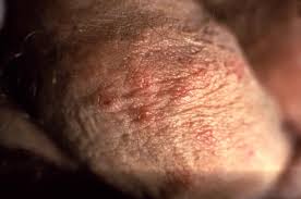 Image result for genital herpes
