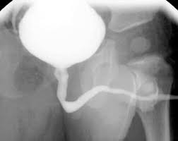 Image result for Voiding Cystourethrogram