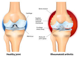 Rheumatoid Arthritis Symptoms Treatment Msk Australia