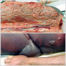 A screening test during pregnancy can tell if you have it. The Brief Case A Fatal Case Of Necrotizing Fasciitis Due To Multidrug Resistant Acinetobacter Baumannii Journal Of Clinical Microbiology