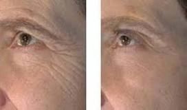 Image result for how long vivace laser treatment is lasting?