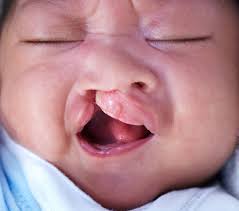 Image result for Cleft Lip