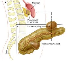 Symptoms can include pain, swelling, redness, and warmth in the affected leg. Pancreatitis Physiopedia