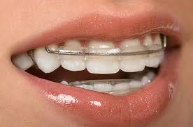 How long do you have to wear braces? Straightening Teeth Without Braces Cardiff Cardiff Dental