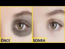 Goz Alti Morlugu Nasil Gecer Gozalti Torbalarina Cozum Guzellik Bakim Youtube Guzellik Gozler Cilt Bakimi