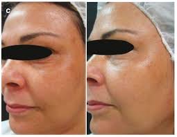 HUYẾT TƯƠNG GIÀU TIỂU CẦU TRONG TRẺ HÓA DA