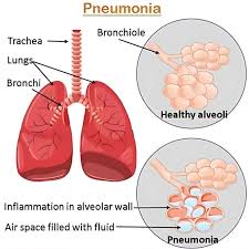 Image result for Pneumonia