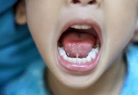 Image result for Ankyloglossia