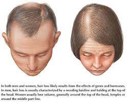 Hair loss typically begins in the 20s and 30s, although in women the changes are most noticeable after menopause. Hereditary Hair Loss In Women Dr Health Clinic