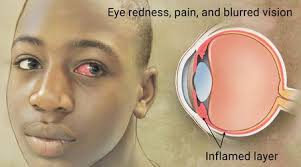 Image result for Uveitis