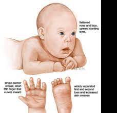Down Syndrome Screen 3 On Flowvella Presentation Software For Mac Ipad And Iphone