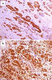Skip to content search menu this is cancer.net's guide to mesothelioma. Invasive Pleural Malignant Mesothelioma With Rib Destruction And Concurrent Osteosarcoma In A Dog Acta Veterinaria Scandinavica Full Text