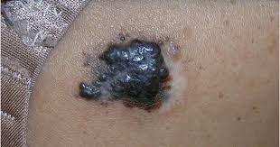 We did not find results for: Galeria Sobre El Cancer De Piel