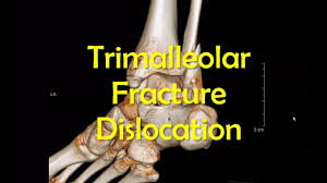 Displaced fracture of medial malleolus of left tibia, initial encounter for closed fracture. Trimalleolar Ankle Fracture Dislocation Reduction Youtube