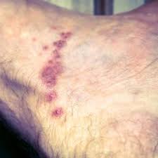 Skin Rash 68 Pictures Causes And Treatments