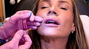 Restylane Kysse Lip Filler: Why the Cannula Method is a Game Changer!