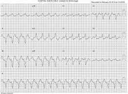 Pe ecg, blocul av de tip i apare ca un interval pr prelungit. Epicardial Ablation Of Ventricular Tachycardia Using A New High Density Mapping System Sciencedirect