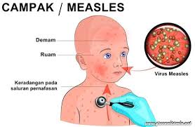 Check spelling or type a new query. Pin On Campak Measles