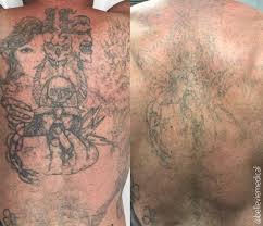 Our laser specialists have extensive experience removing . Tattoo Removal The 411 Belle Vie Wellness Aesthetics