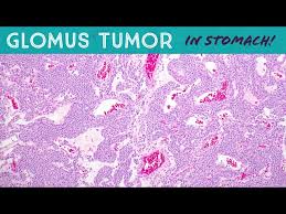Image result for Glomus tumor