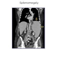 Image result for Splenomegaly