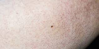 It is usually found on the outer areas of the upper arms, thighs, and cheeks. Ask A Dermatologist Keratosis Pilaris Columbia Skin Clinic