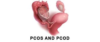 Medical illustration of polycystic ovaries, PCOS and PCOD