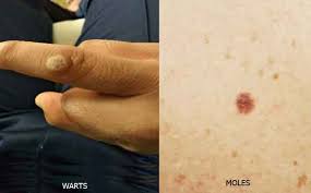Moles may change in appearance or fade away over time. How To Get Rid Of Skin Tags And Moles Best Way To Remove Warts Tibot