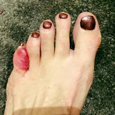 But if a blister opens, it becomes at risk for infection, says arnold, so don't try to pop them! Blisters Between Toes 7 Expert Ways To Prevent Blister Prevention