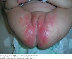 Image result for diaper dermatitis