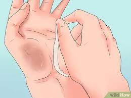 An gelenken, so sollte das entsprechende gelenk geschient werden, um eine bewegung der haut an der stelle zu unterbinden. Steri Strips Entfernen 9 Schritte Mit Bildern Wikihow