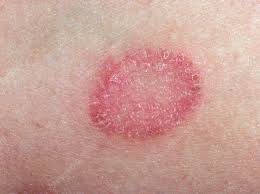 Molte persone si chiedono come sapere se hanno i funghi ai piedi, dal momento che è una cosa molto fastidiosa, che a volte può essere confusa con altri problemi della pelle e. Croste Antibiotici Bendaggi Vero E Falso Delle Piu Comuni Infezioni Della Pelle Corriere It