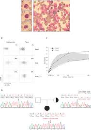 Genetic counselors usually work in a hospital or clinic. Frontiers Case Report Partial Uniparental Disomy Unmasks A Novel Recessive Mutation In The Lyst Gene In A Patient With A Severe Phenotype Of Chediak Higashi Syndrome Immunology