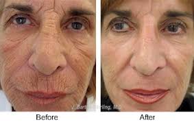 Chemical peels improve the appearance of wrinkled skin by using a chemical solution to remove the outer layer of old skin. Chemical Peel Laser Skin Treatments J Barton Sterling Md
