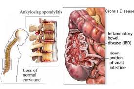 Pin By Kara Gonsalves On Healthcare Ankylosing Spondylitis Crohns Disease Crohns