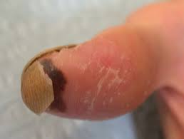 Chemical Burns | Dermnet