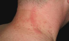 Raupendermatitis Online Diagnose Therapie Von Hautarzten