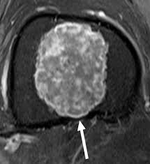 Image result for Chondrosarcoma