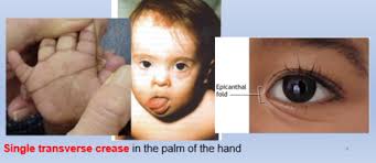 This optical illusion causes the patient to have an appearance of eyes deviated nasally, and it is most apparent when the eyes are in side gaze or are focusing up close. Cytogenetics 3 Flashcards Quizlet