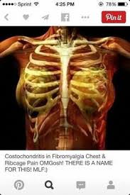 Costochondritis In Fibromyalgia Chronicfatigueawareness Costochondritis Fibromyalgia Chronic Fatigue Syndrome Diet